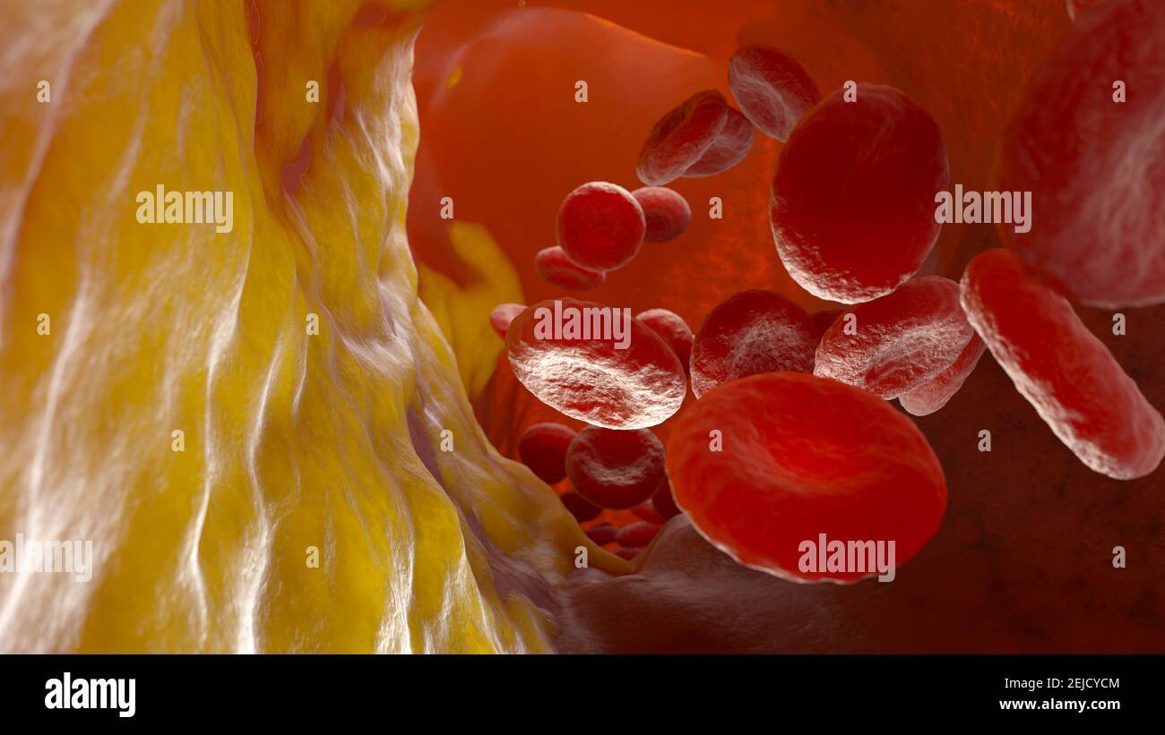 Placca di colesterolo nell'arteria, vaso sanguigno con cellule del sangue fluenti. Illustrazione 3D Foto Stock