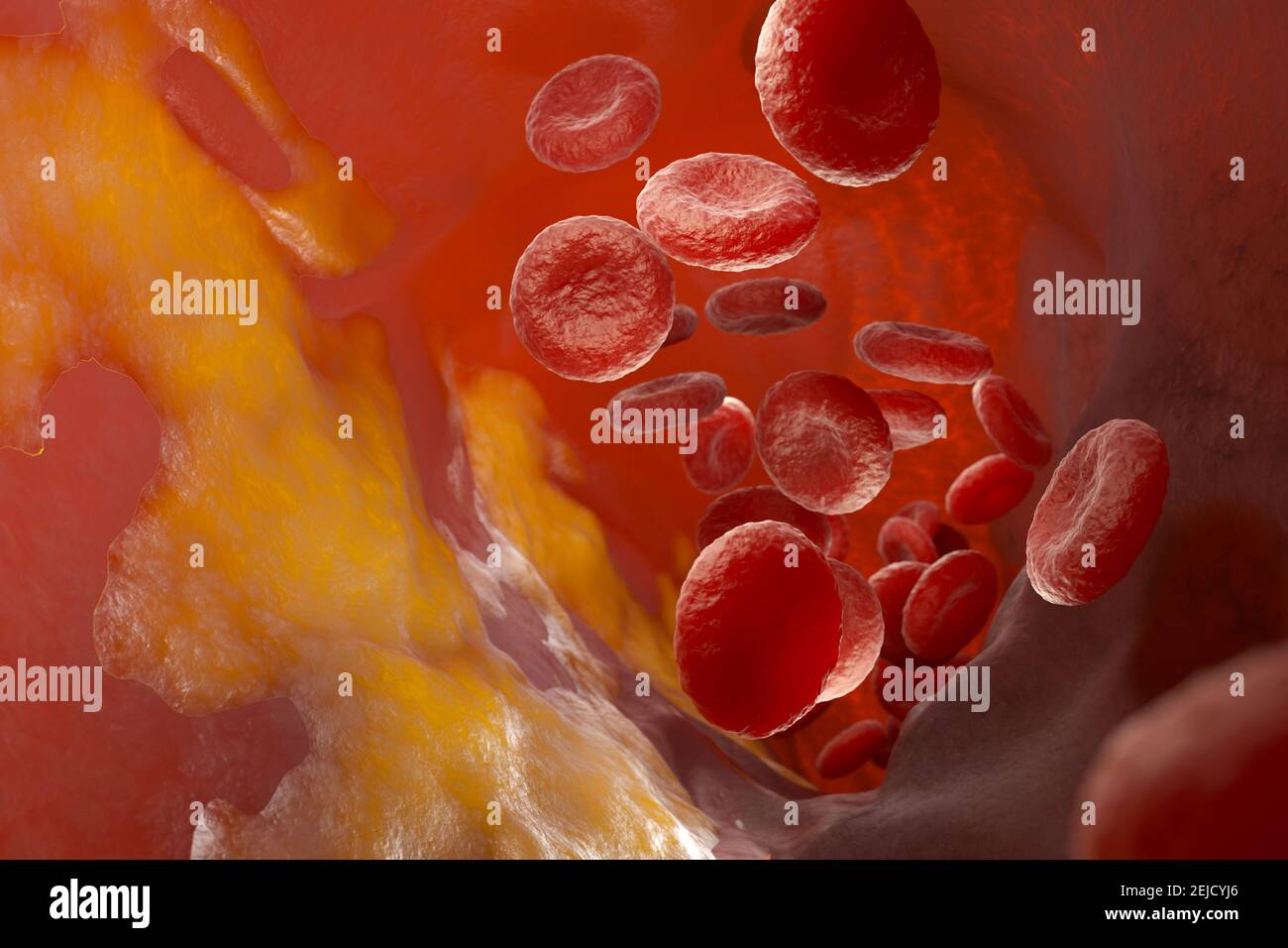 Placca di colesterolo nell'arteria, vaso sanguigno con cellule del sangue fluenti. Illustrazione 3D Foto Stock