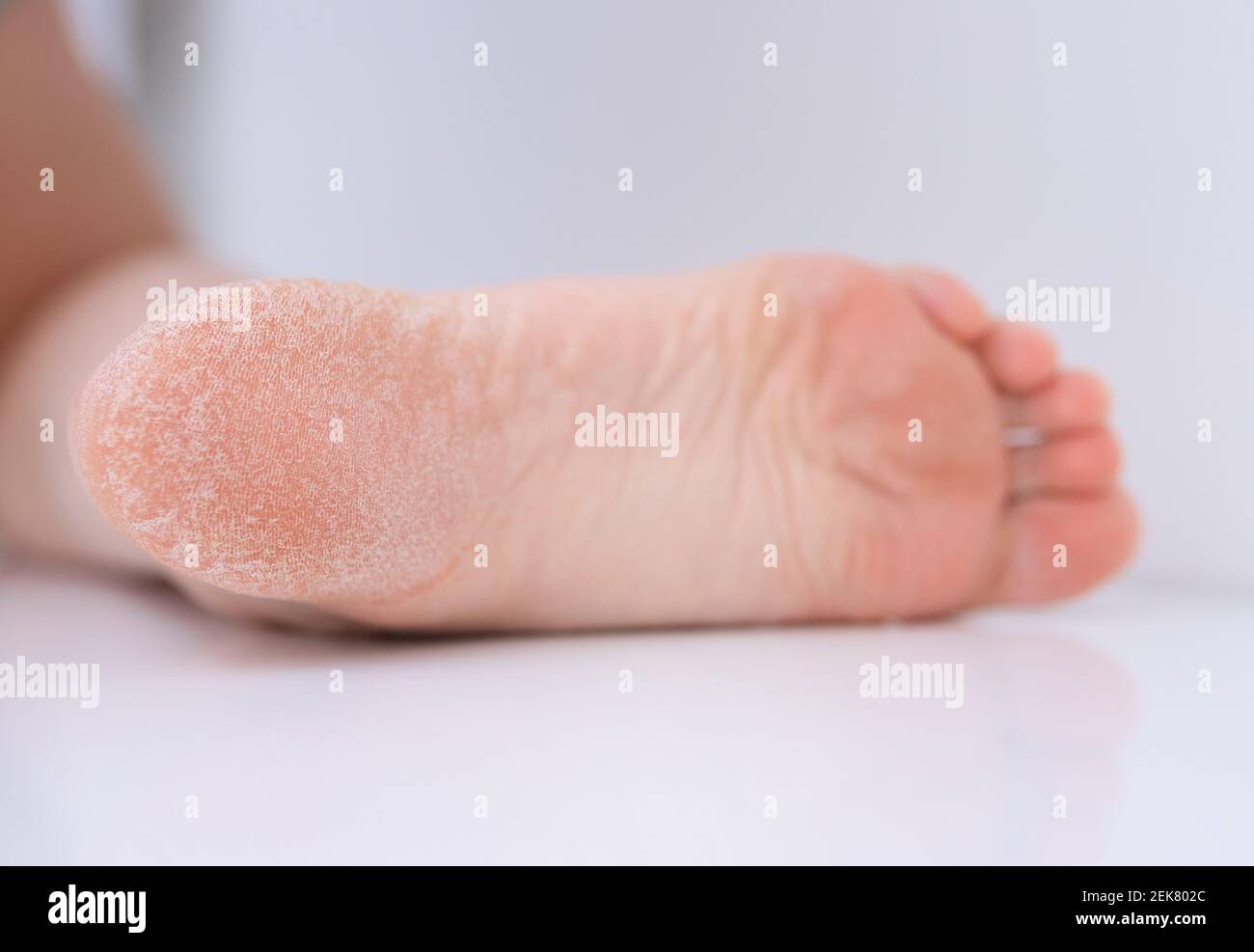 La pelle secca del piede è incrinata. Concetto di trattamento con creme idratanti ed esfoliazione per la guarigione di ferite e dolore durante la camminata. Disidratato s Foto Stock