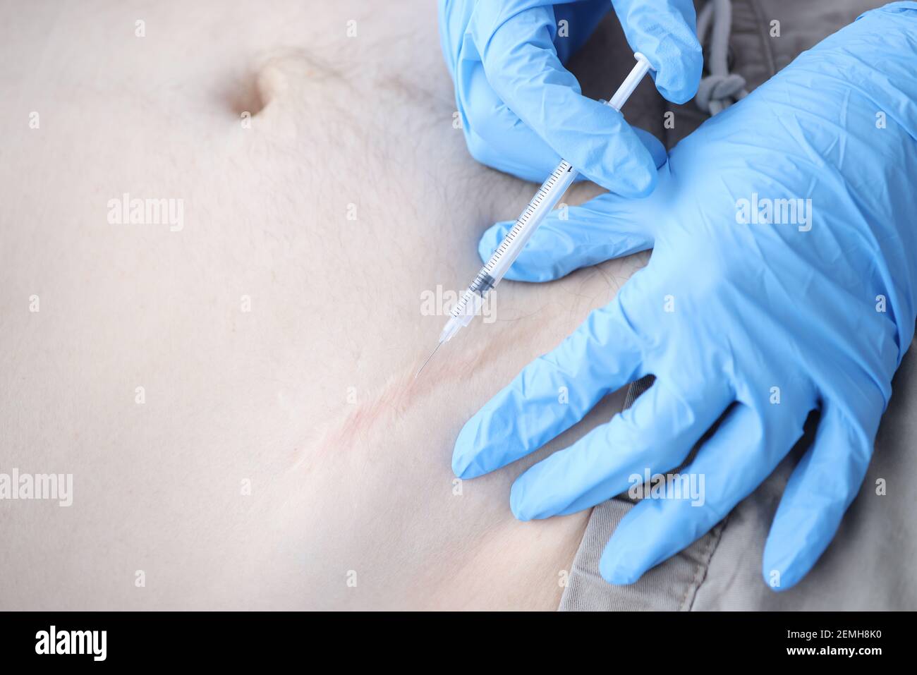 Infermiere iniezione medicinale nei pazienti closeup della cicatrice postoperatoria Foto Stock
