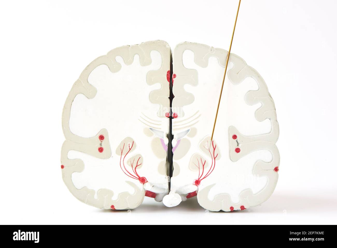 Registrazione microelettrodo di globus pallidus interna o GPI in chirurgia della malattia di Parkinson. Modello cerebrale ed elettrodo su sfondo bianco. Foto Stock