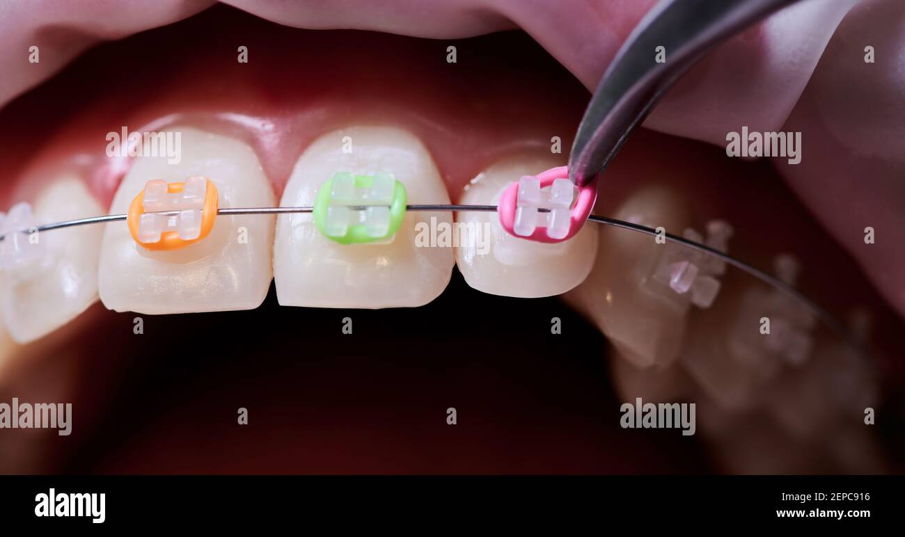 Fasce elastiche ortodontiche e posizionatori, 500 fasce di trazione dentali in gomma, 5 pezzi di supporto elastico per bretelle (1/4 , volpe Fasce elastiche ortodontiche e posizionatori, 500 fasce di trazione dentali in gomma, 5 pezzi di supporto elastico per bretelle (1/4 , volpe