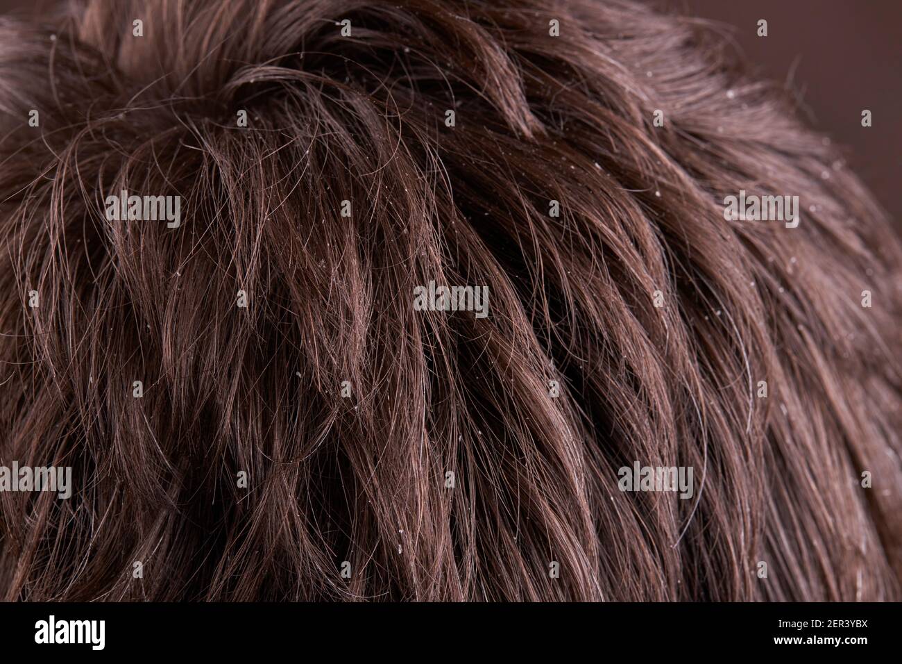 persona di sesso maschile con malattia di forfora. assistenza sanitaria dermatologica Foto Stock