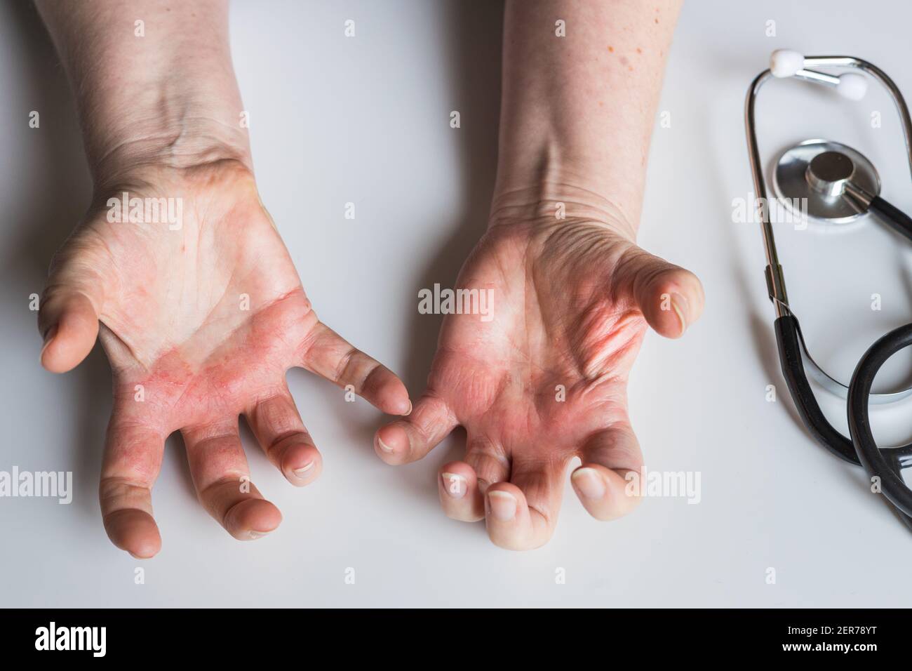 Mani rosse, pruriginose con vesciche. Dermatite atopica. Una visita ad un dermatologo, uno stetoscopio sulla scrivania Foto Stock