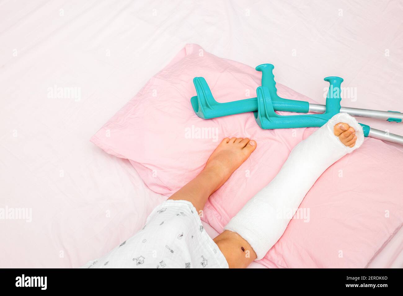 Fratture ossee sulla gamba di un bambino. Gamba per bambini in un getto sul letto con stampelle nelle vicinanze.Vista dall'alto Foto Stock