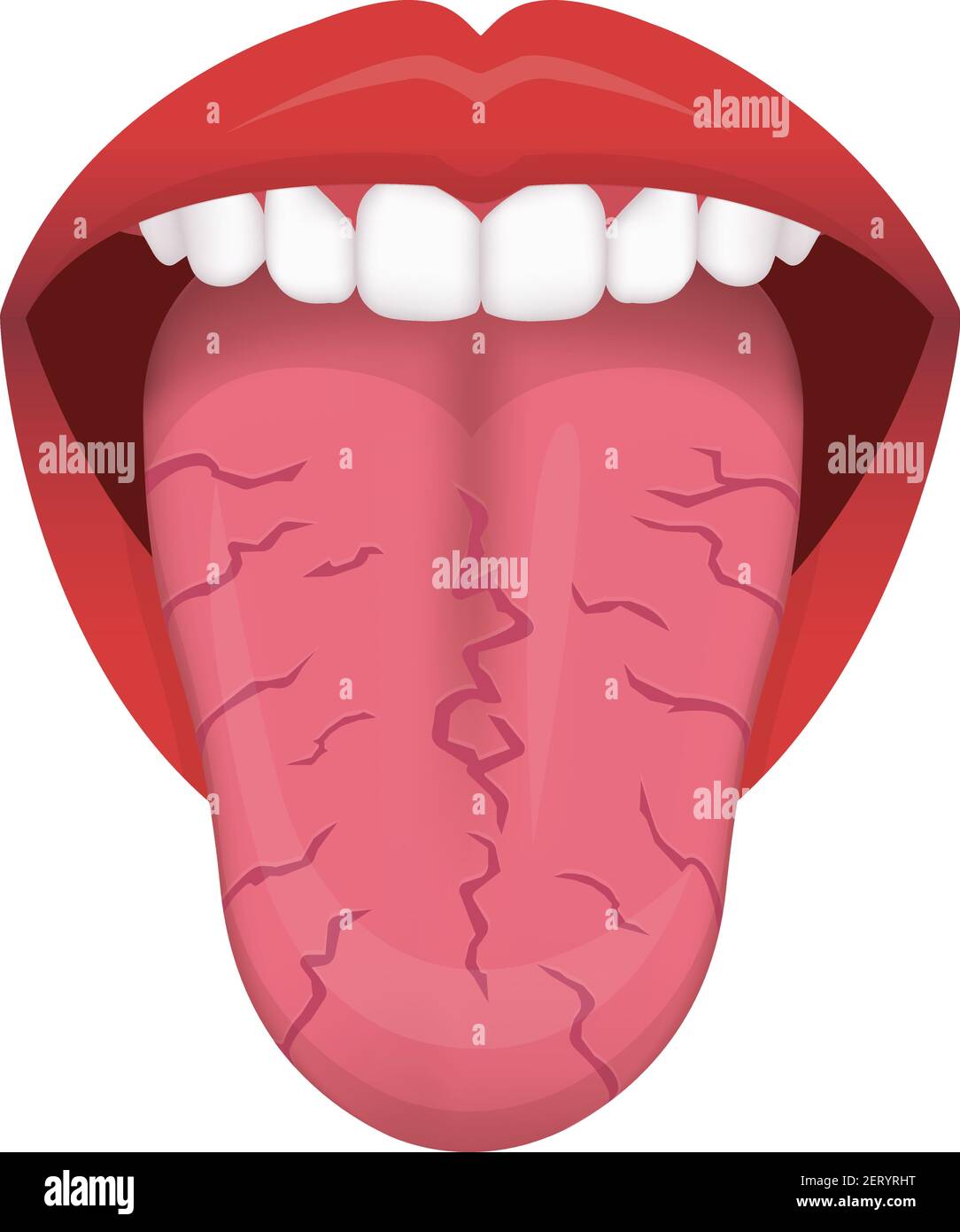 Illustrazione vettoriale dei segni di salute della lingua ( lingua incrinata ) Illustrazione Vettoriale