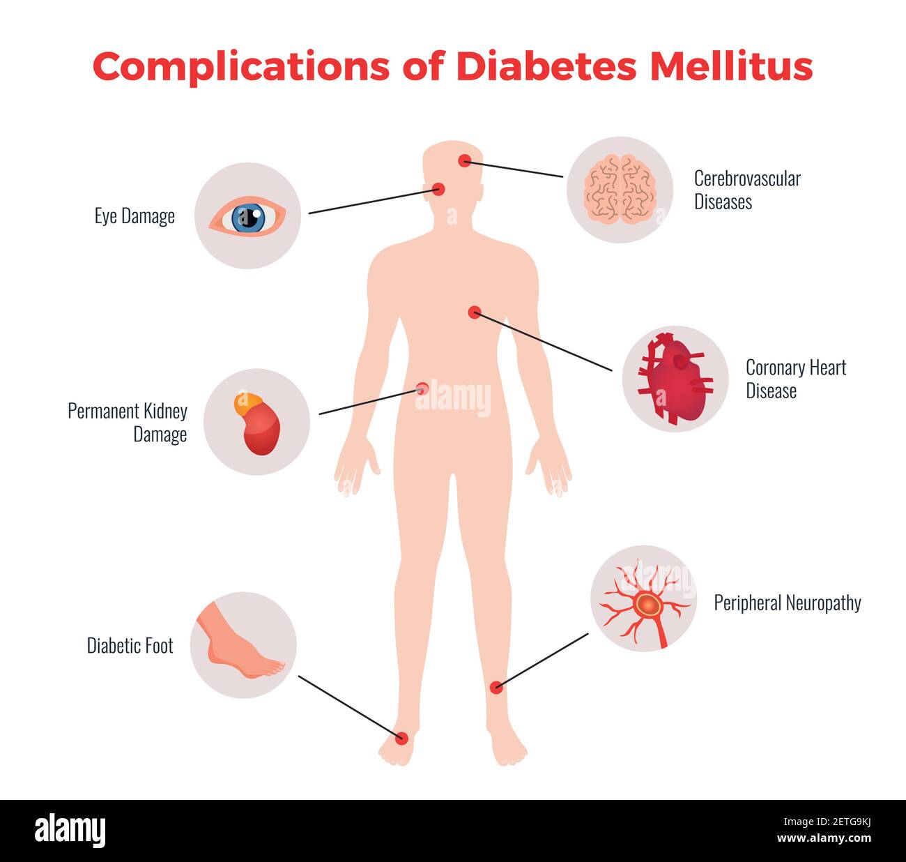 Complicazioni del diabete poster medico educativo con organi umani colpiti illustrazione e descrizione dei danni immagine vettoriale piatta Illustrazione Vettoriale