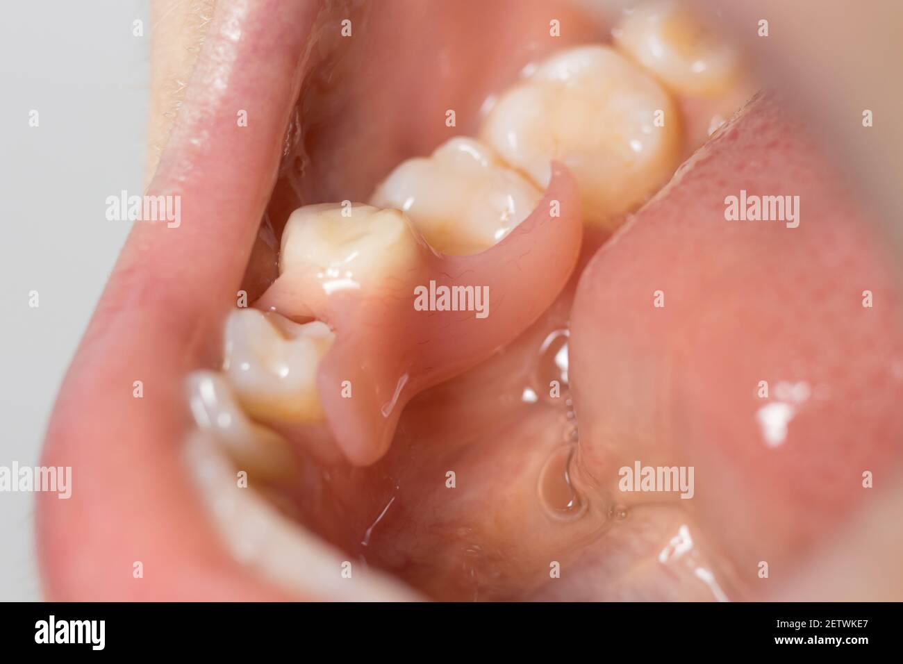 Protesi dentaria artificiale rimovibile nella bocca del paziente. Inserito un molar solitario falso in odontoiatria. Foto Stock