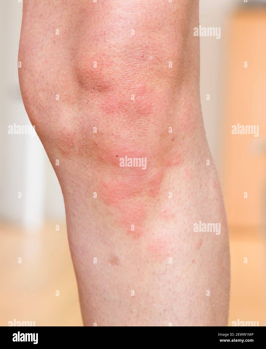 Orticaria, una condizione della pelle. Eruzione cutanea rossa sul corpo di una donna, allergia cutanea, Regno Unito Foto Stock