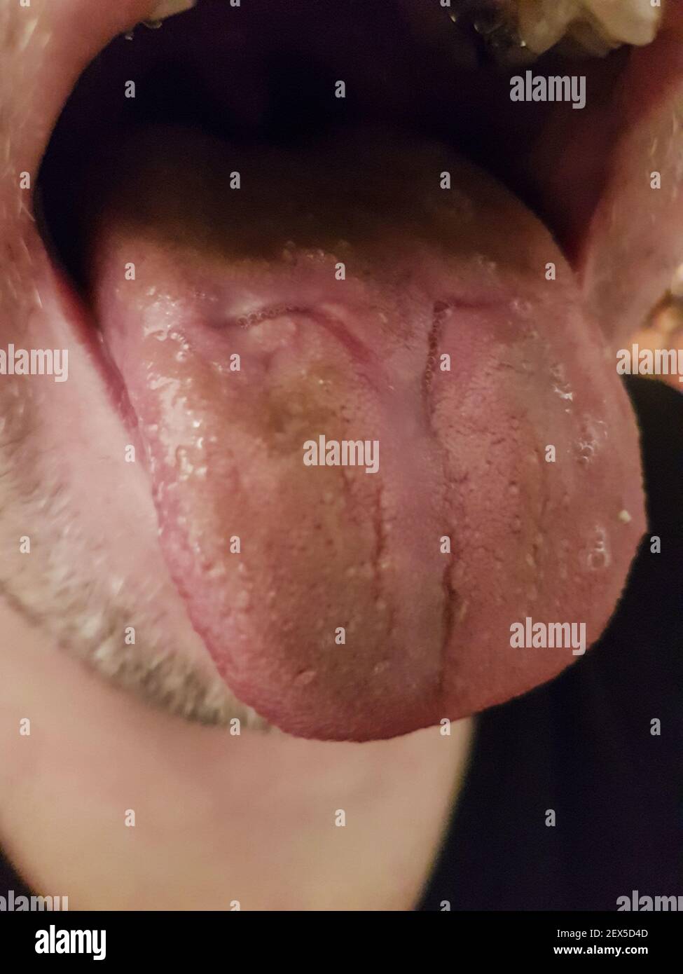 Ferita nella lingua causata da un rotatore molare in bretelle. Sfocato. Foto Stock