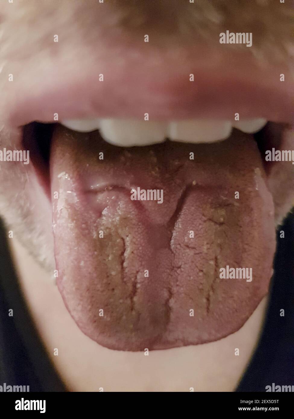 ferita nella lingua causata da un rotatore molare in bretelle. Sfocato. 1 Foto Stock