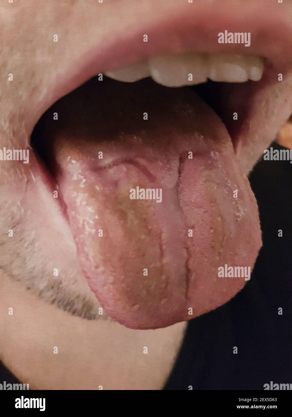 Ferita nella lingua causata da un rotatore molare in bretelle. Sfocato. Foto Stock