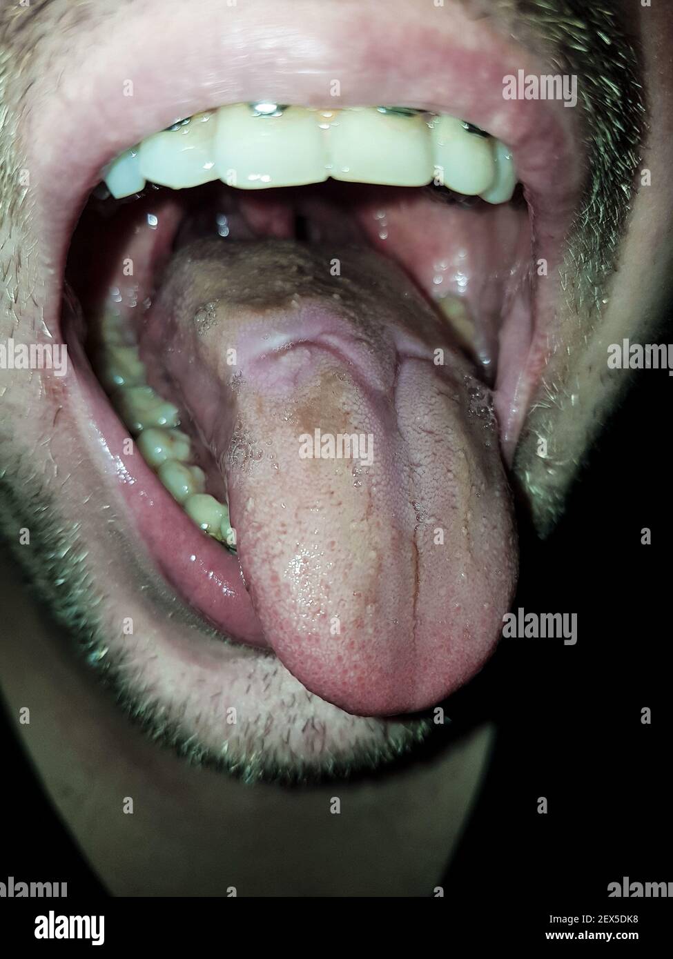 Ferita dentale nella lingua causata da un rotatore molare nei rinforzi. Sfocato. Foto Stock