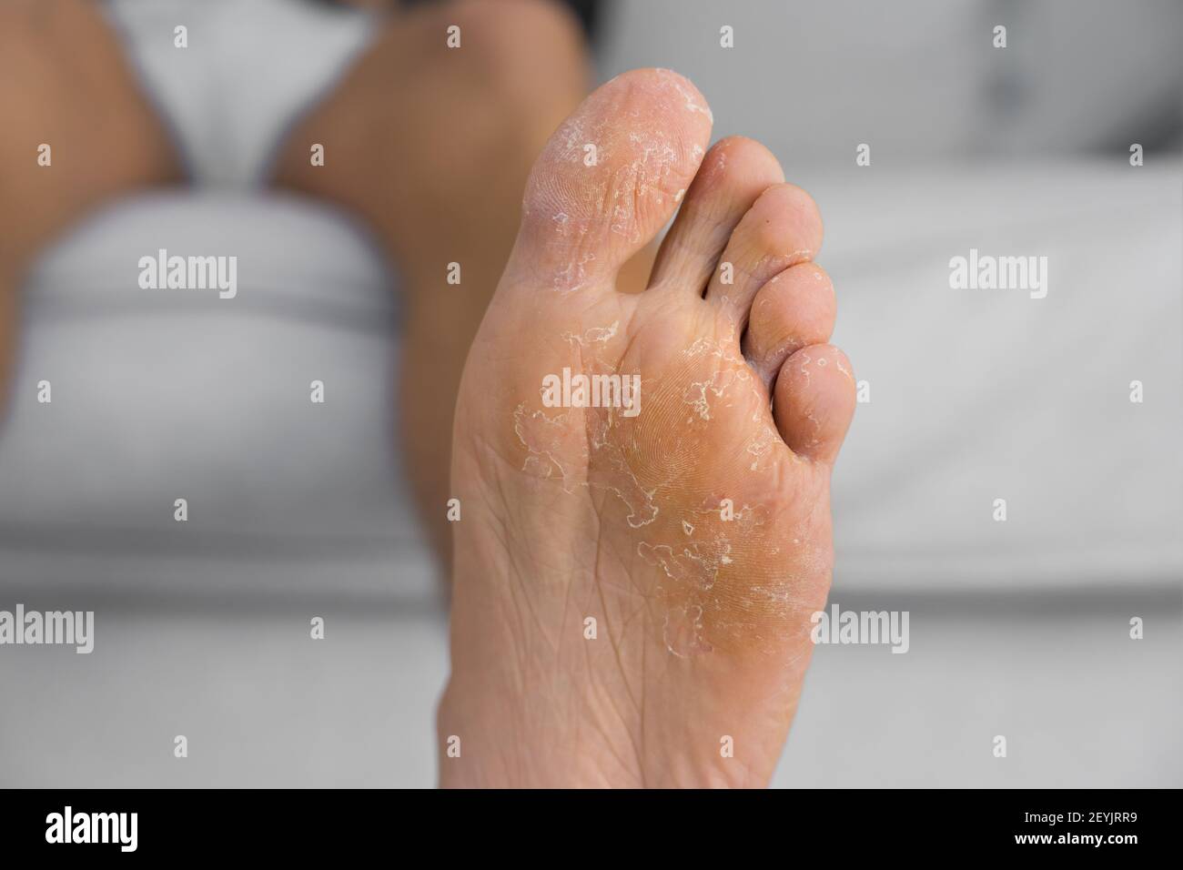 Il piede d'Atleta infezione in piedi del paziente Foto stock - Alamy