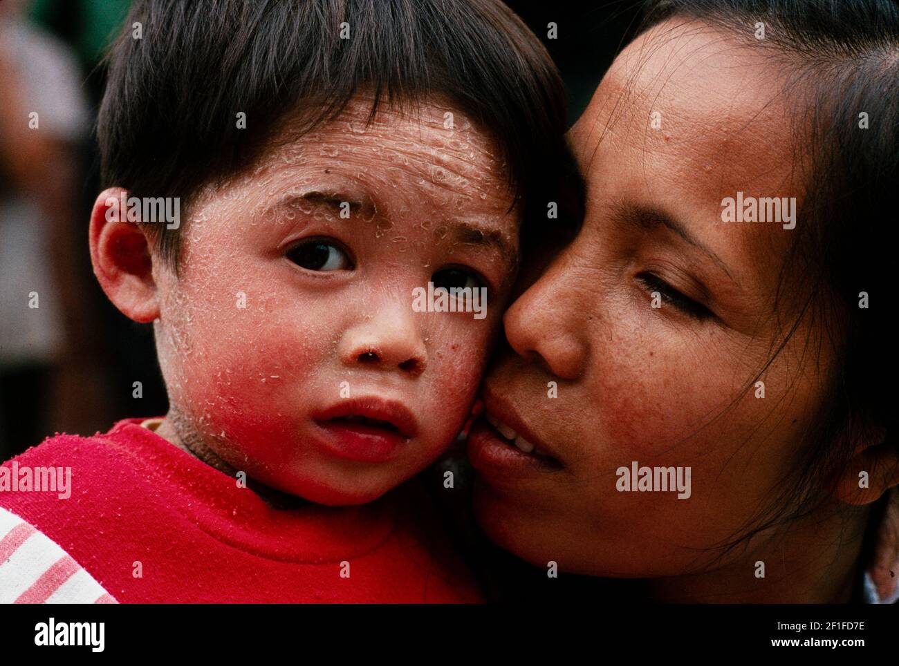 Un ragazzo con problema di peeling della pelle, Ospedale dei Bambini, Hanoi, Vietnam del Nord, Giugno 1980 Foto Stock