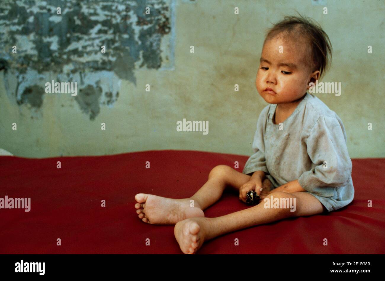 Un bambino malnutrito all'ospedale pediatrico, ho Chi Minh City, Vietnam, giugno 1980 Foto Stock