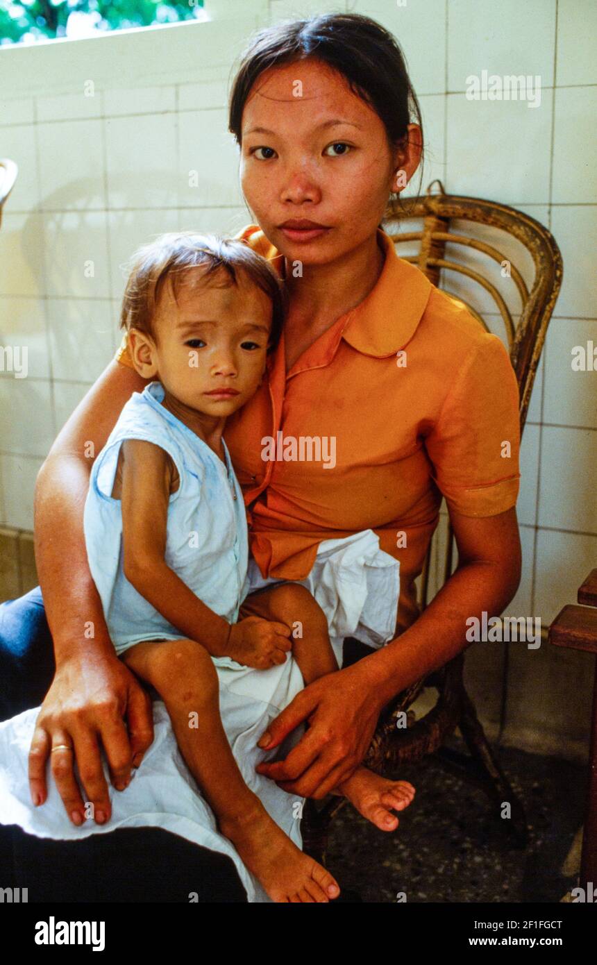 Un bambino malnutrito all'ospedale pediatrico, ho Chi Minh City, Vietnam, giugno 1980 Foto Stock