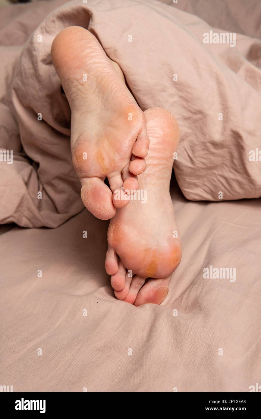 tallone nelle crepe degli strisci sulle gambe trattamento dermatologico cura, pelle persona dolore mani corpo, soletta callosità. Condizione di disordine di disidratazione Foto Stock