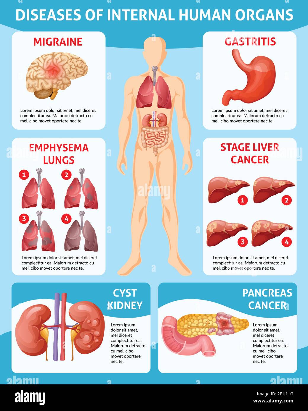 Concetto infografico di Cartoon Medical care con diverse malattie interne illustrazione vettoriale degli organi umani Illustrazione Vettoriale