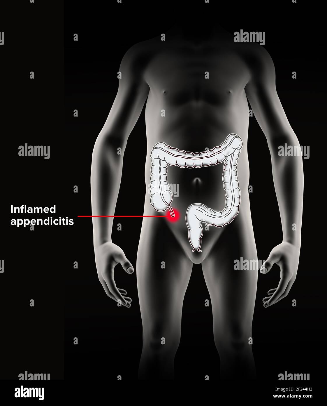 L'appendice è un tubo cieco, a forma di dito, collegato al cecum. Il cecum è una struttura a sacca del colon. rendering 3d. Appendicite Foto Stock
