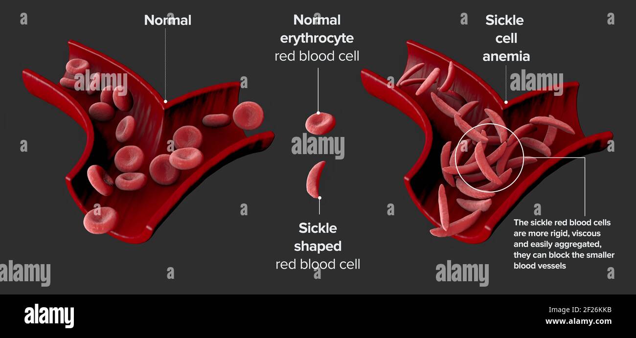 La malattia a cellule falciformi è un gruppo di disturbi del sangue. Anemia falciforme. Ciò provoca un'anomalia nell'emoglobina proteica che trasporta ossigeno Foto Stock