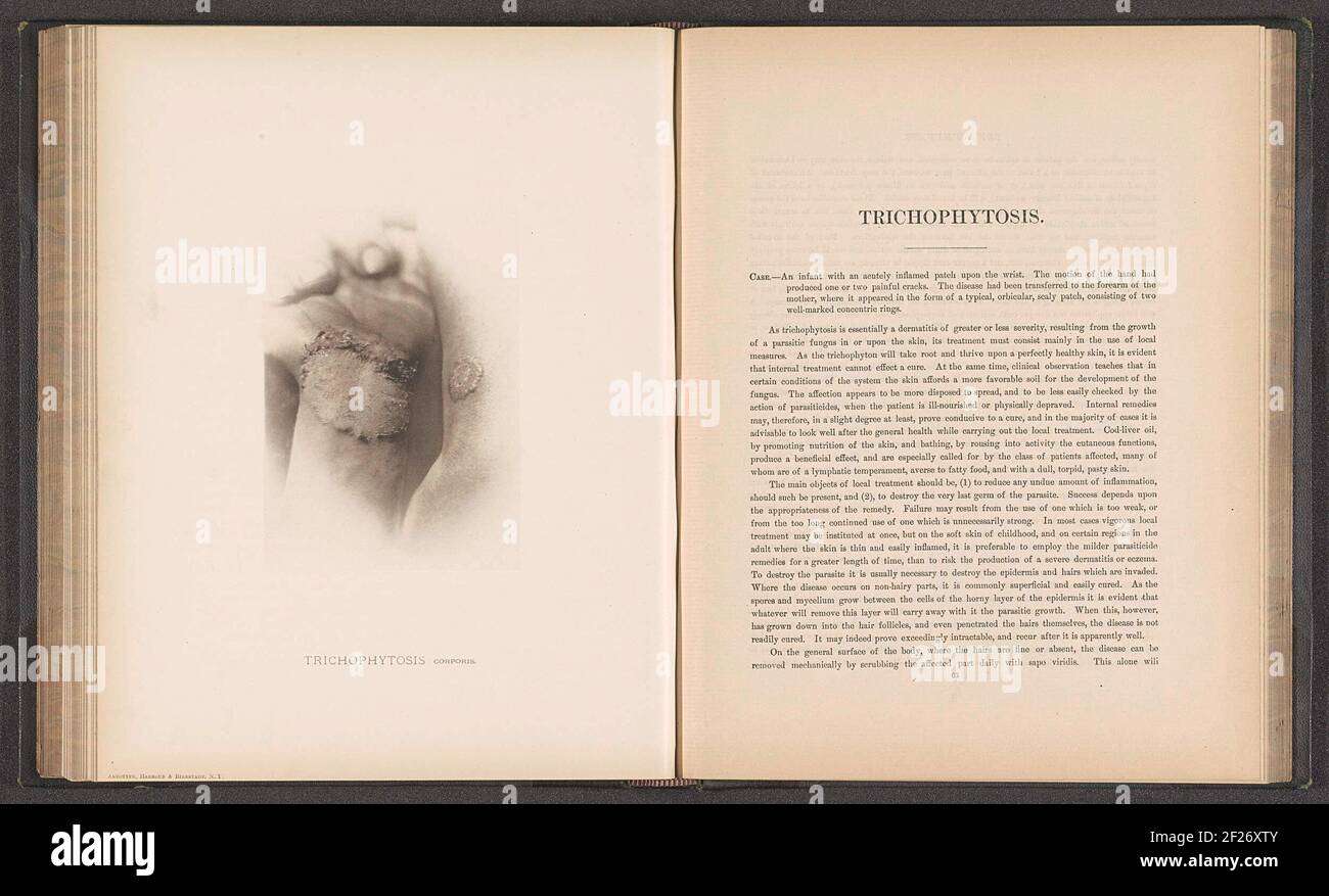 Paziente affetto dalla malattia della pelle 'Trichophytosis corporis'; Trichophytosis corporis .. Foto Stock