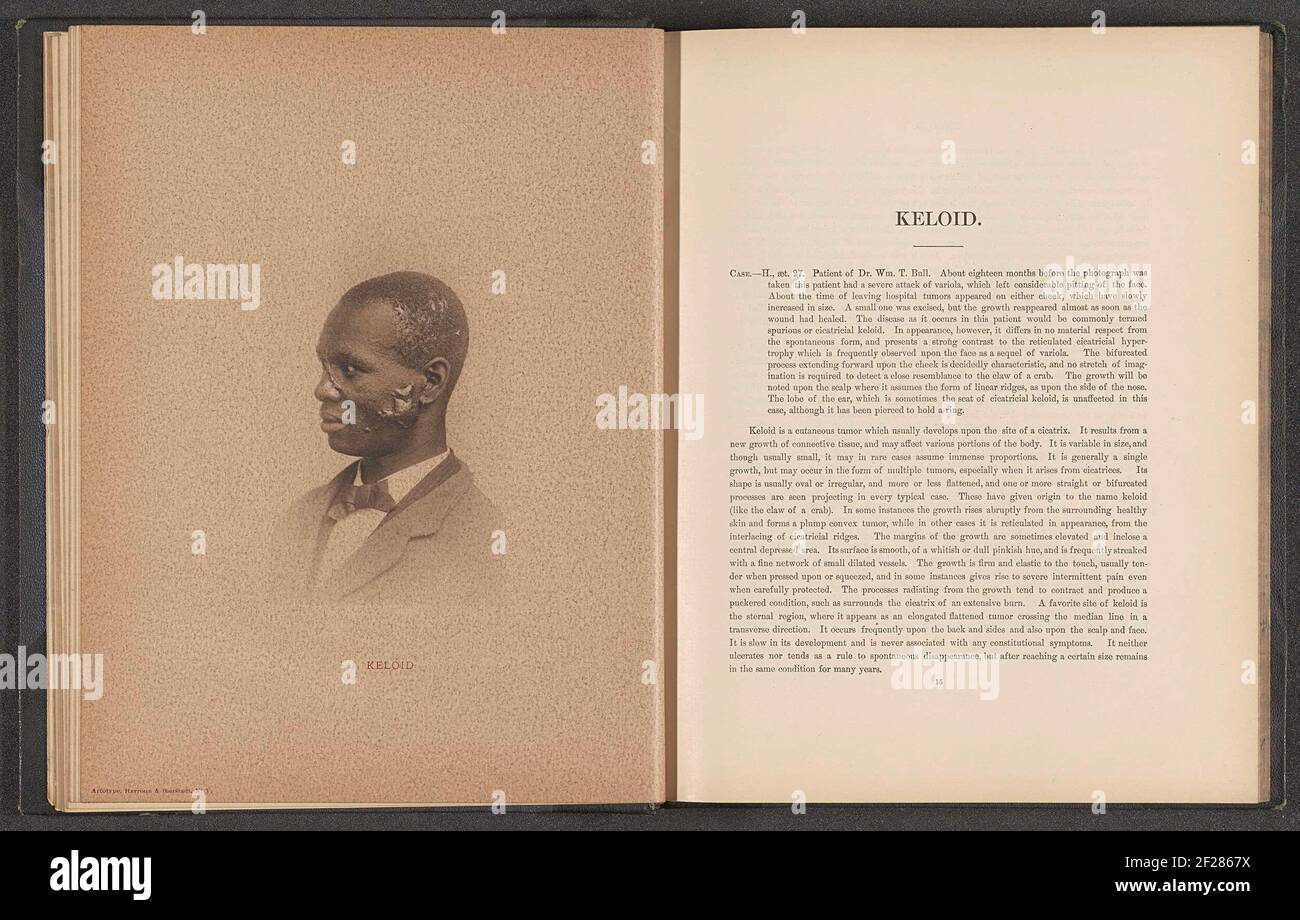 Paziente affetto dalla malattia della pelle 'keloid'; keloid .. Foto Stock