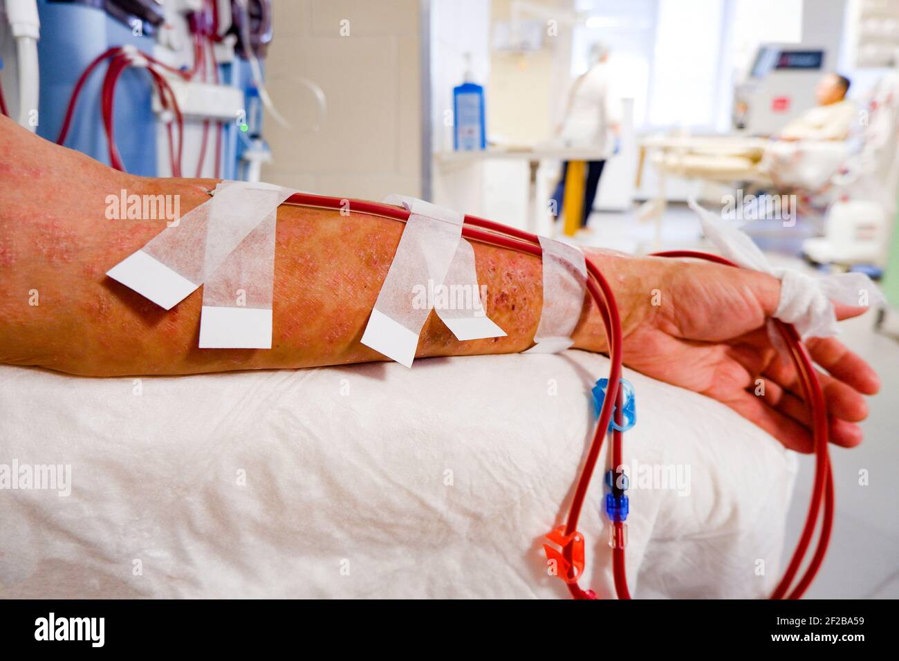la mano di un paziente con una lesione cutanea è collegata a un apparecchio per emodialisi. Foto Stock