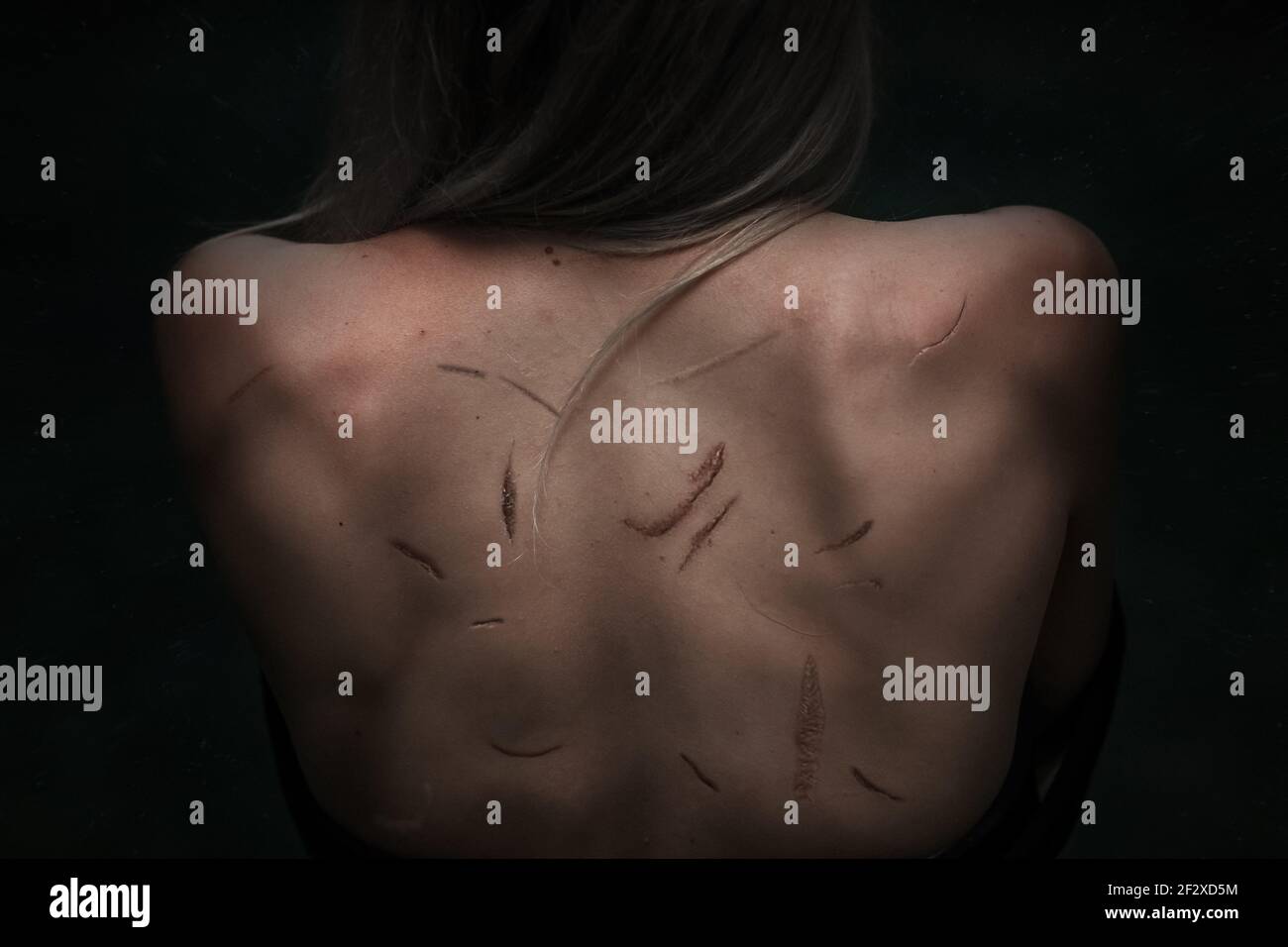 Primo piano della schiena femminile con molte cicatrici esso Foto Stock