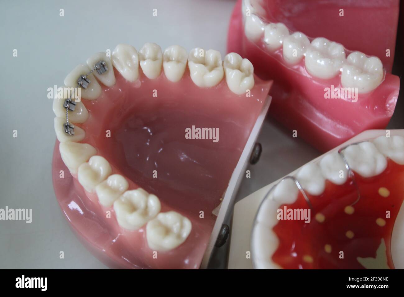 Closeup di modelli dentali che mostrano diversi tipi di trattamento ortodontico Foto Stock