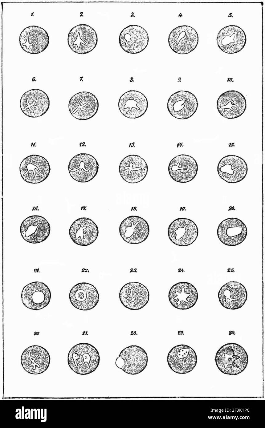 Alterazioni del plasmodio di un corpuscolo ematico. Foto Stock