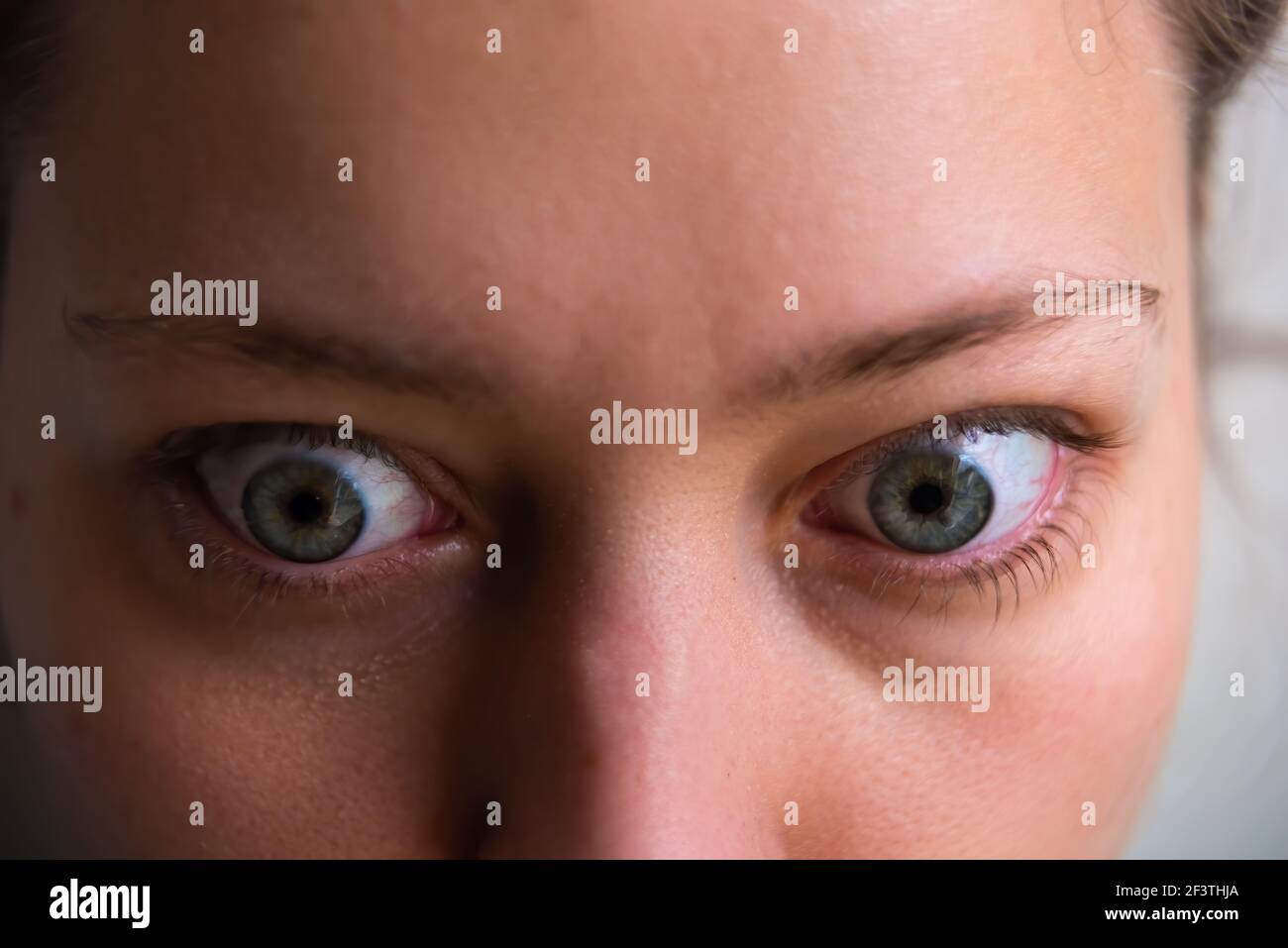 Macro closeup di giovane donna faccia con malattia di grave ipertiroidismo sintomi di oftalmopatia bulging occhi proposi edema Foto Stock