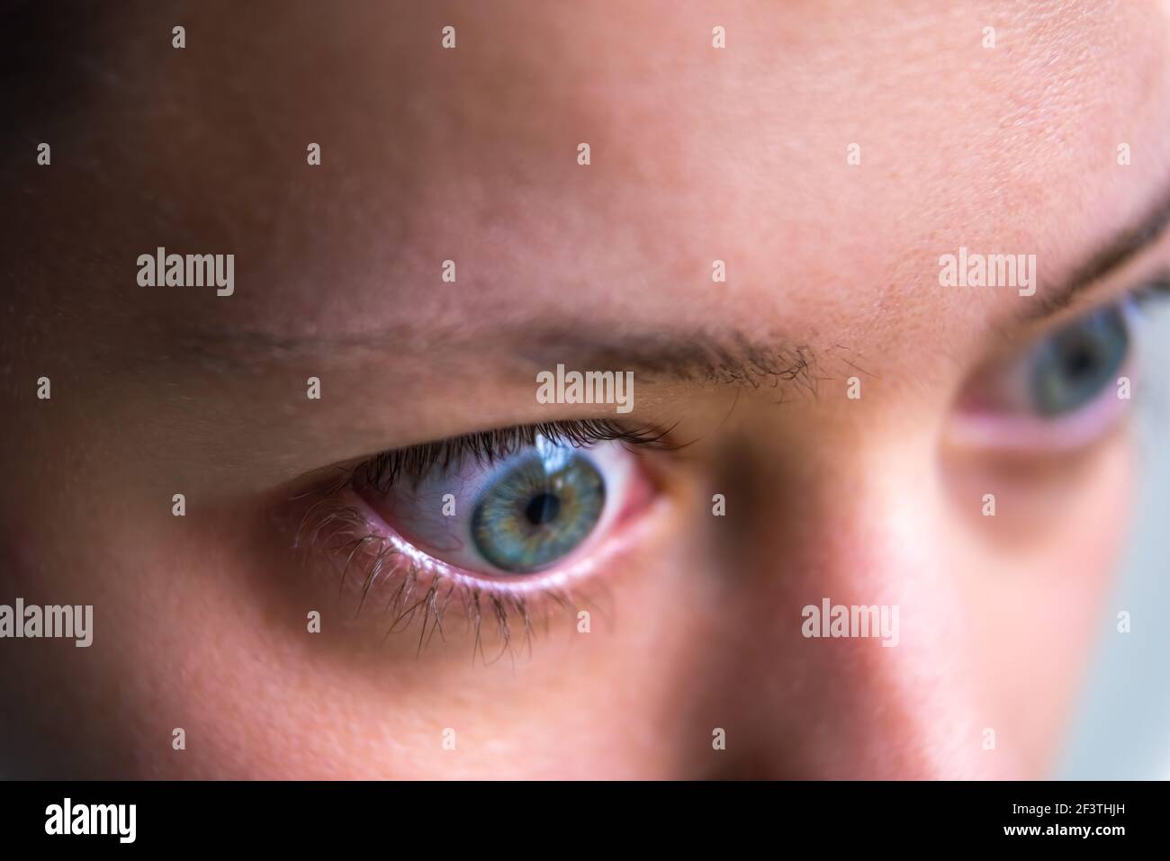 Macro primo piano profilo ritratto di giovane donna volto con grave malattia ipertiroidismo sintomi di oftalmopatia gonfiore degli occhi e propertosi edema Foto Stock