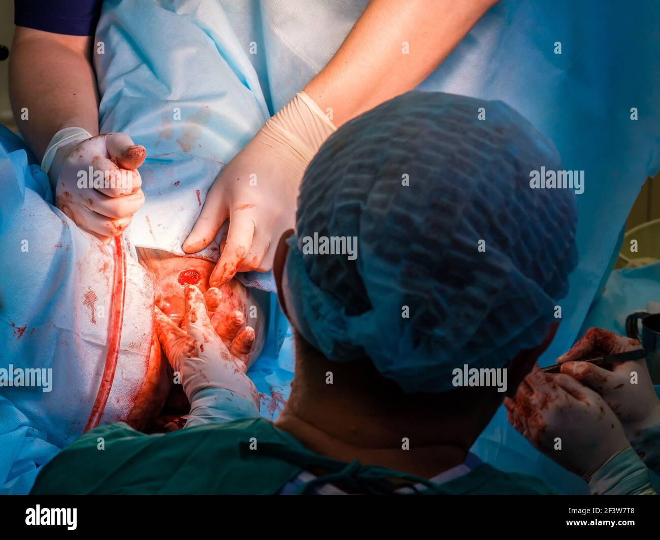 I chirurghi utilizzano strumenti medici per eseguire un intervento proctologico minimamente invasivo sull'ano per rimuovere le emorroidi. Primo piano delle mani Foto Stock