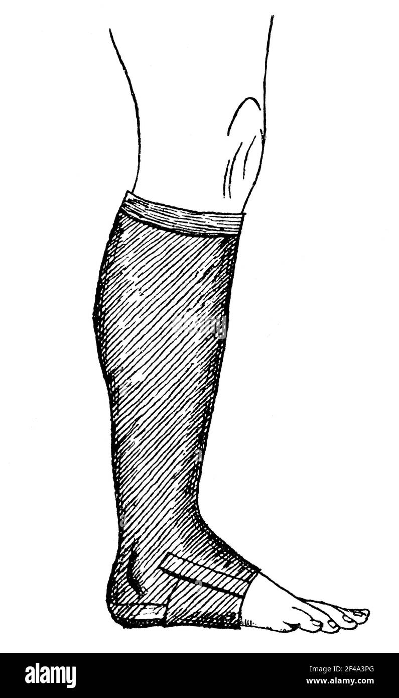Calza in tessuto elastico per vene varicose. Illustrazione del 19 ° secolo. Germania. Sfondo bianco. Foto Stock