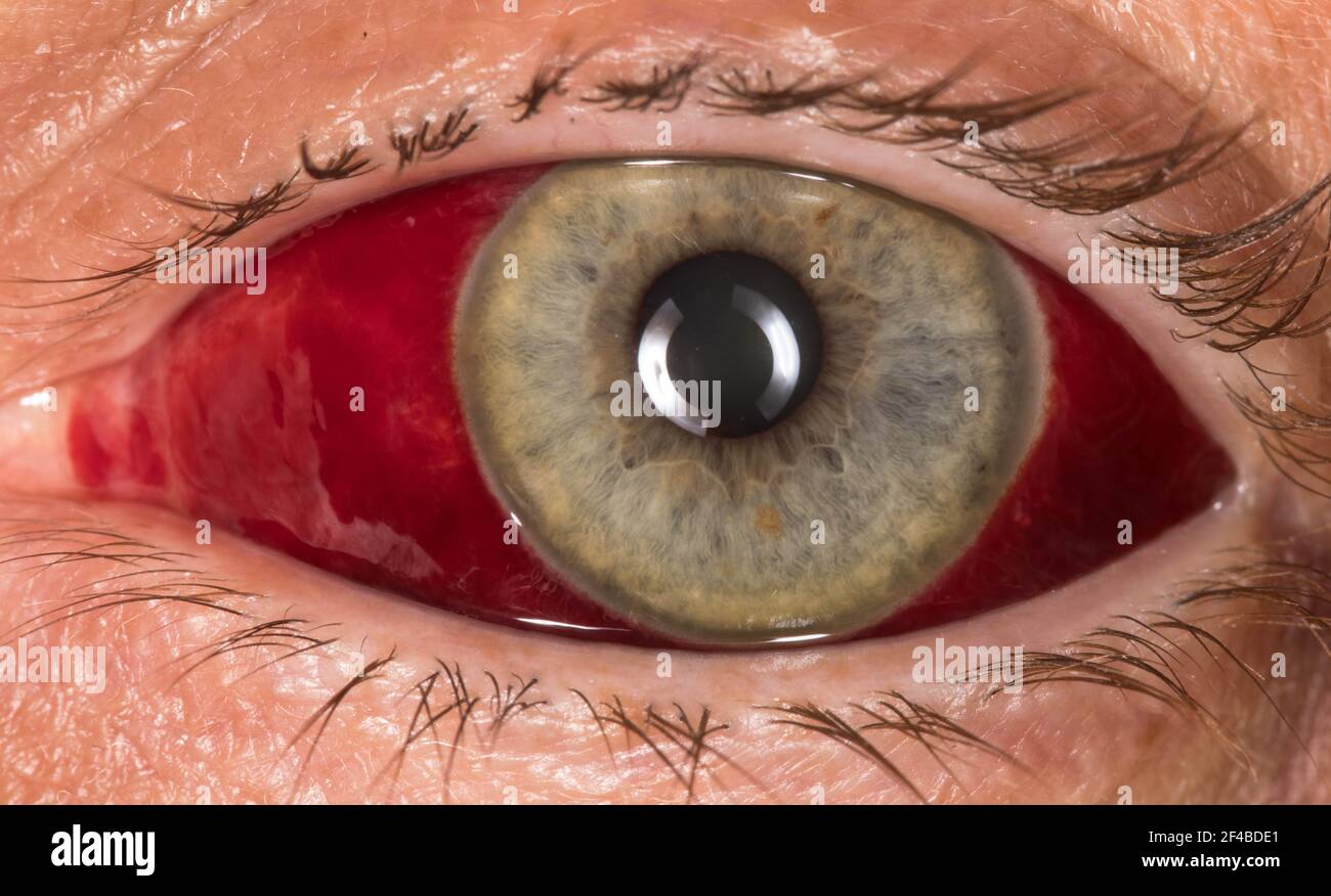 Occhio umano con emorragia subcongiuntivale rottura del vaso sanguigno da vicino. Errore medico Foto stock Alamy
