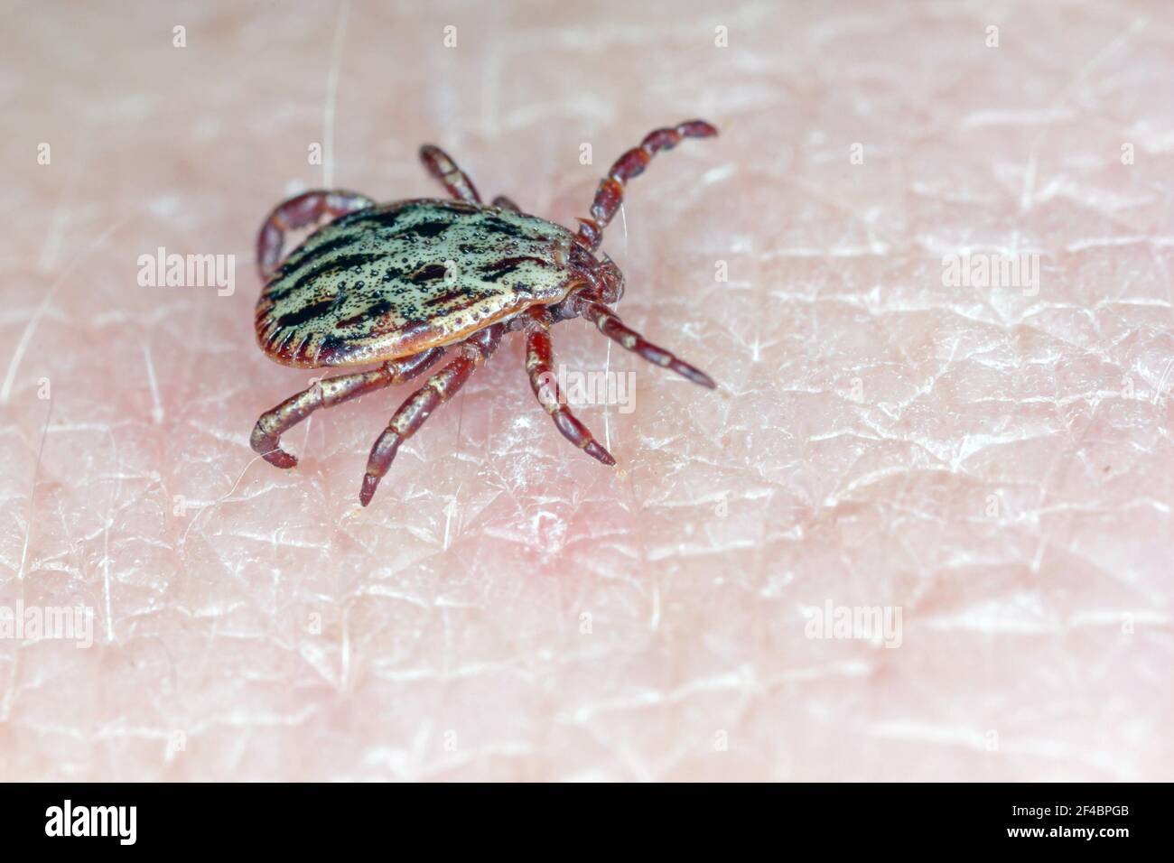 Tick camminare sulla pelle umana. Ingrandimento elevato. Foto Stock