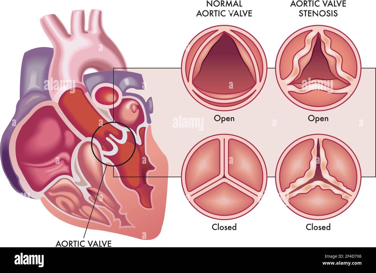 L'illustrazione medica mostra la differenza tra una valvola aortica normale e una con stenosi, aperta e chiusa, e la sua posizione nel cuore, con un Illustrazione Vettoriale