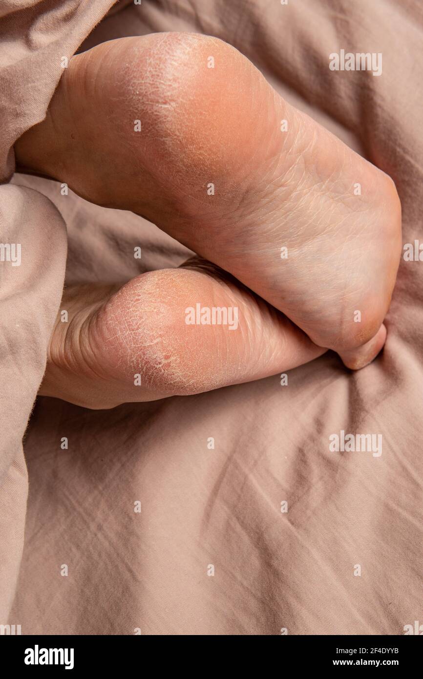 Tallone nelle crepe degli strisci sulle gambe trattamento dermatologico a piedi nudi, dermatite secca del tallone, dermatologo eczema atleti, condizione Foto Stock
