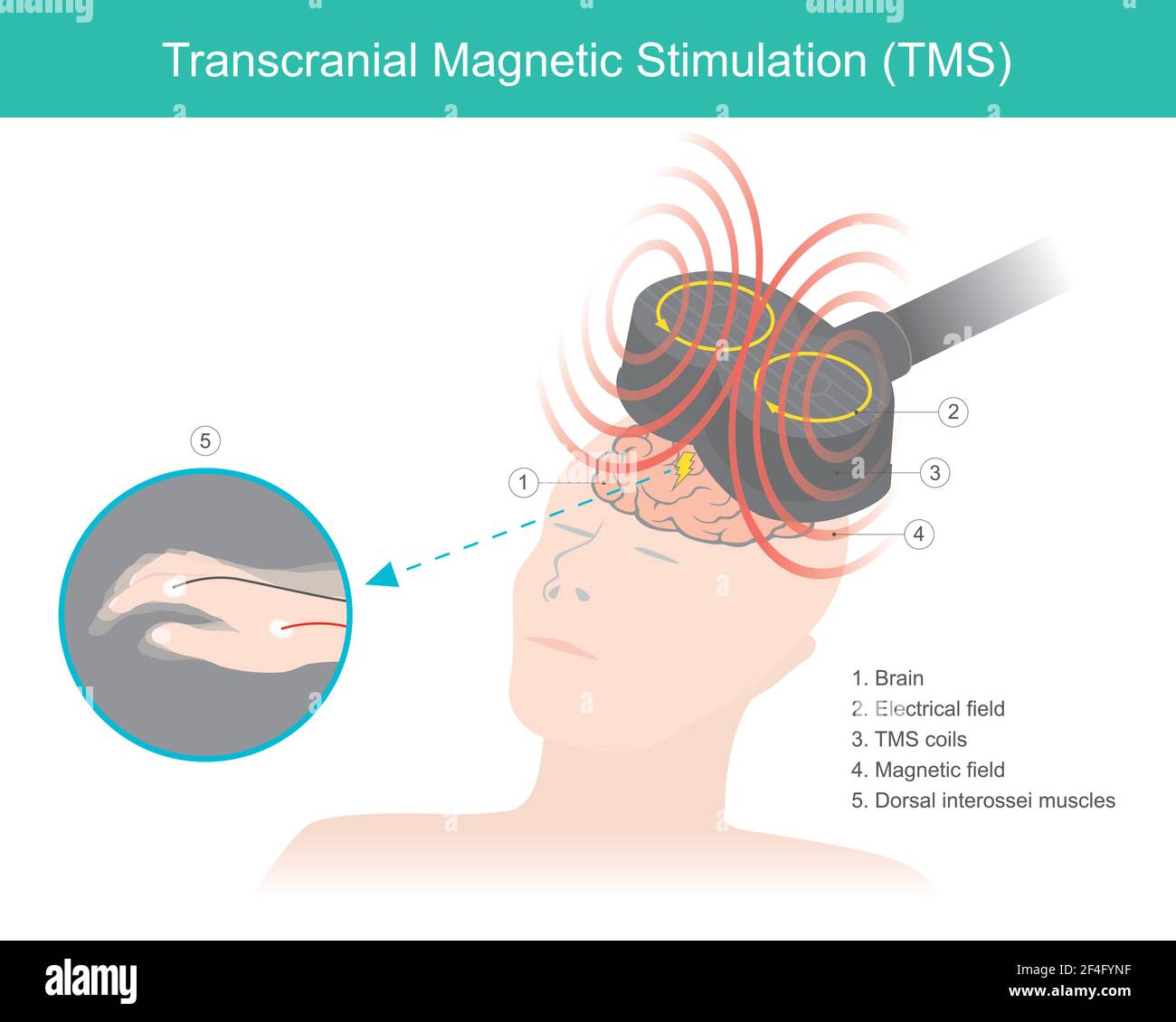 Stimolazione magnetica transcranica (TMS). La stimolazione cerebrale in cui un campo magnetico variabile viene utilizzato per causare corrente elettrica. Assistenza sanitaria e io Illustrazione Vettoriale