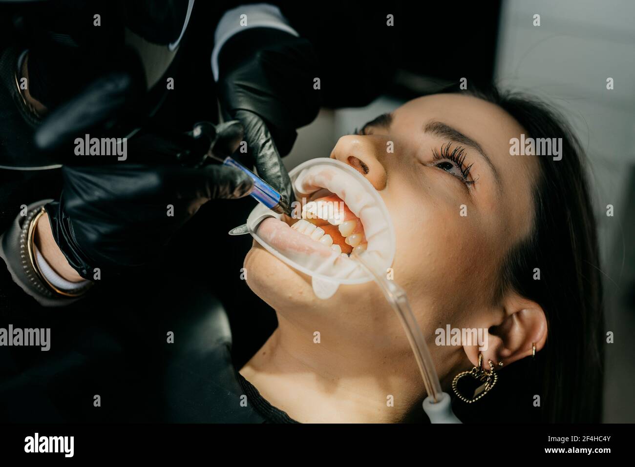 Crop dentista irriconoscibile che capovolgono la pasta fotosensibile mentre si trattano i denti di femmina con eiettore di saliva e divaricatore in bocca Foto Stock