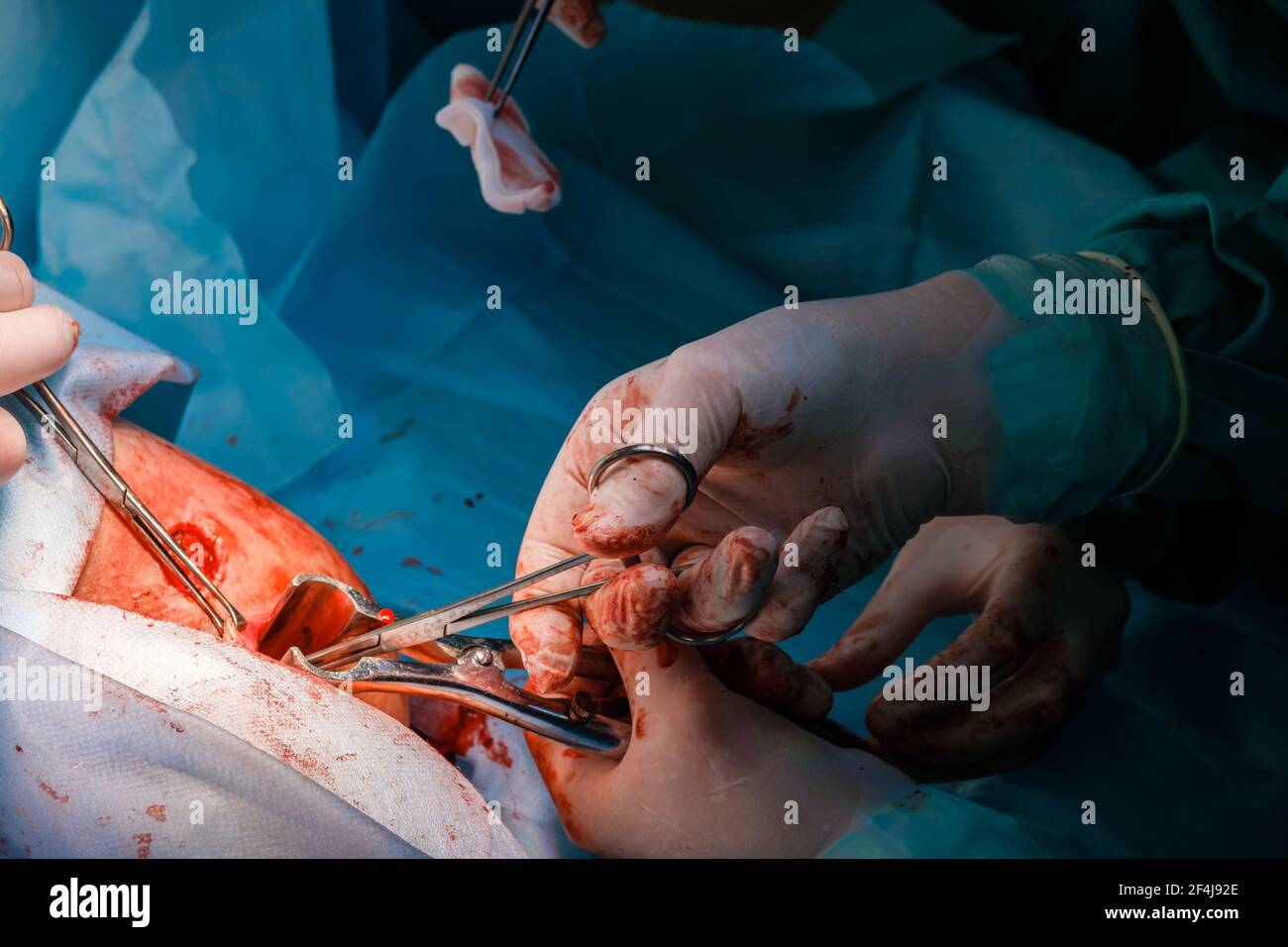 I chirurghi utilizzano strumenti medici per eseguire un intervento proctologico minimamente invasivo sull'ano per rimuovere le emorroidi. Primo piano delle mani Foto Stock
