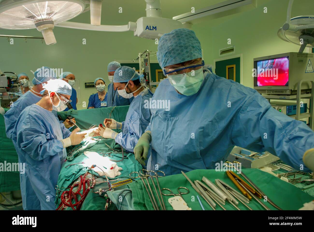 Consulente cardiologo Ciro Campanella (indossando l'ottica), e il suo team, eseguendo la chirurgia cardiaca all'Edinburgh Royal Infirmary, Edimburgo, Scozia Foto Stock