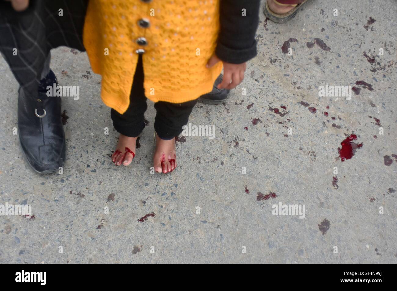 21 marzo 2021: Srinagar, Kashmir. 21 marzo 2021. Persone di diverse età, compresi i bambini, ricevono un trattamento di leech in Srinagar, nel Kashmir indiano somministrato, alla vigilia di Nowruz o del capodanno persiano. Hirudotheraphy o la terapia Leech è una delle più antiche terapie complementari in Kashmir, dove è usato per trattare un certo numero di disturbi tra cui sinusite, condizioni della pelle, artrite, congelamento, e mal di testa. L'uso medico delle faggi risale all'antico Egitto, dove il sangue era una pratica comune per prevenire e curare le malattie (Credit Image: © Muzamil Mattoo/IMAGESLIVE via ZUMA Wire Foto Stock