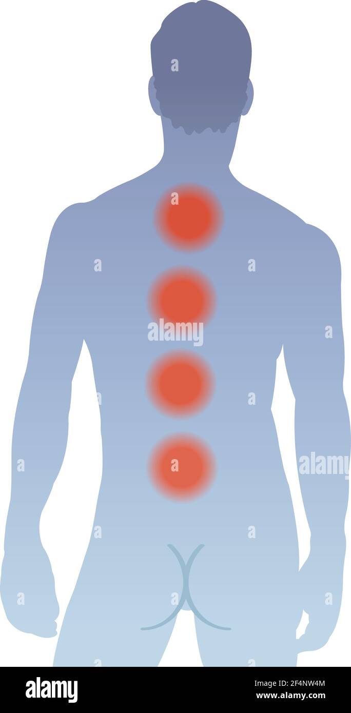 L'illustrazione mostra le principali aree di dolore alla schiena dell'uomo, causate dal mieloma multiplo. Illustrazione Vettoriale