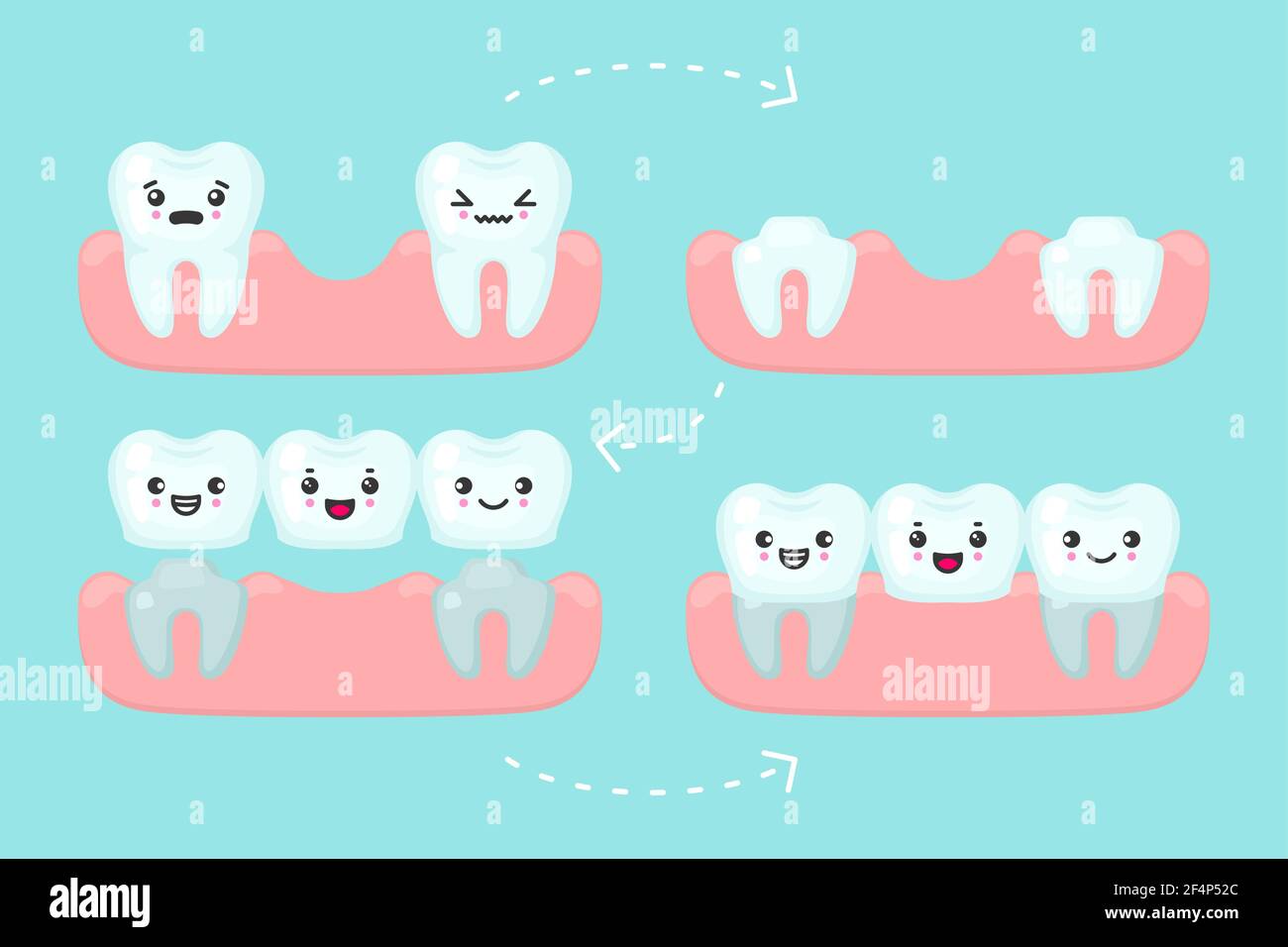 Impostazione del ponte dentale, illustrazione del concetto vettoriale di stomatologia dentale Illustrazione Vettoriale