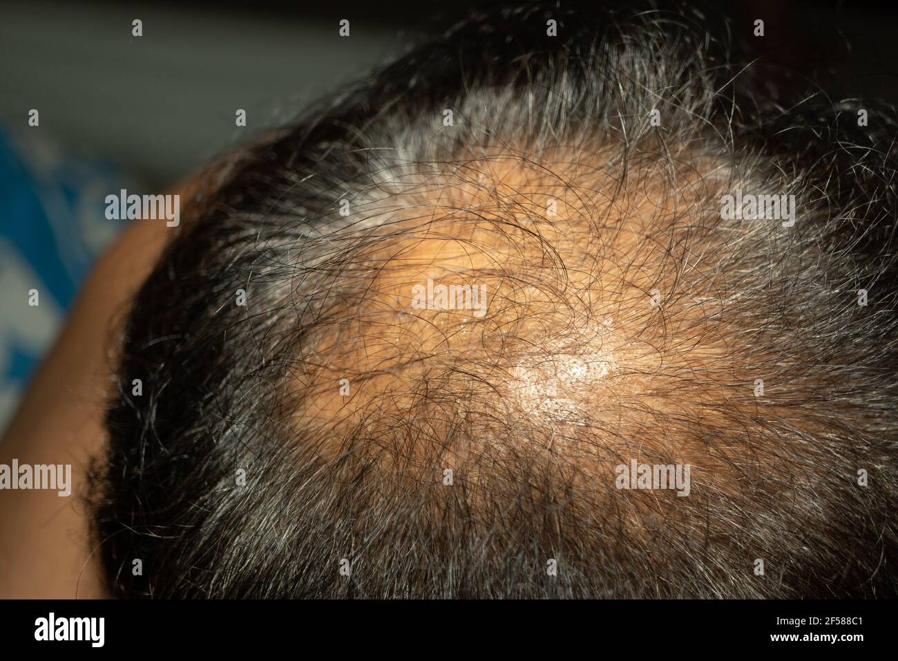 Primo piano calvizie spot. Alopecia Areata. Foto Stock