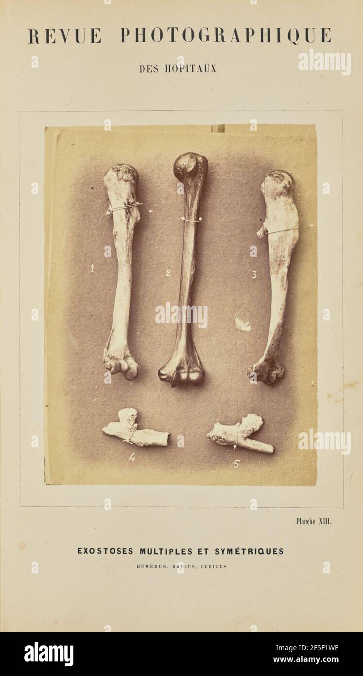 Exostoses miples et symétriques, humérus, RADIUS, cubitus. Arthur de Montmeja (francese, nato nel 1841) Foto Stock
