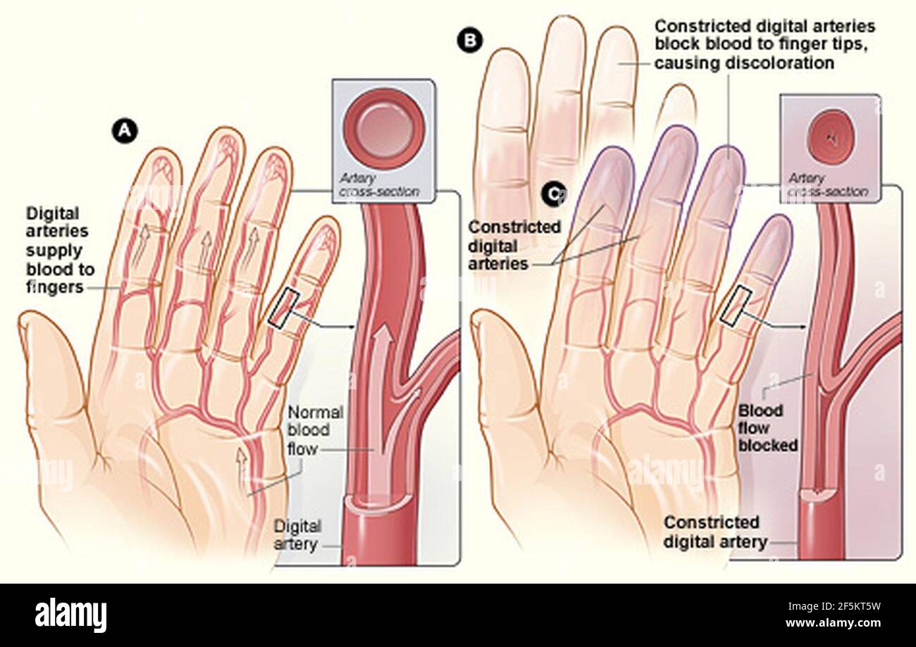 Malattia di Raynaud. Foto Stock