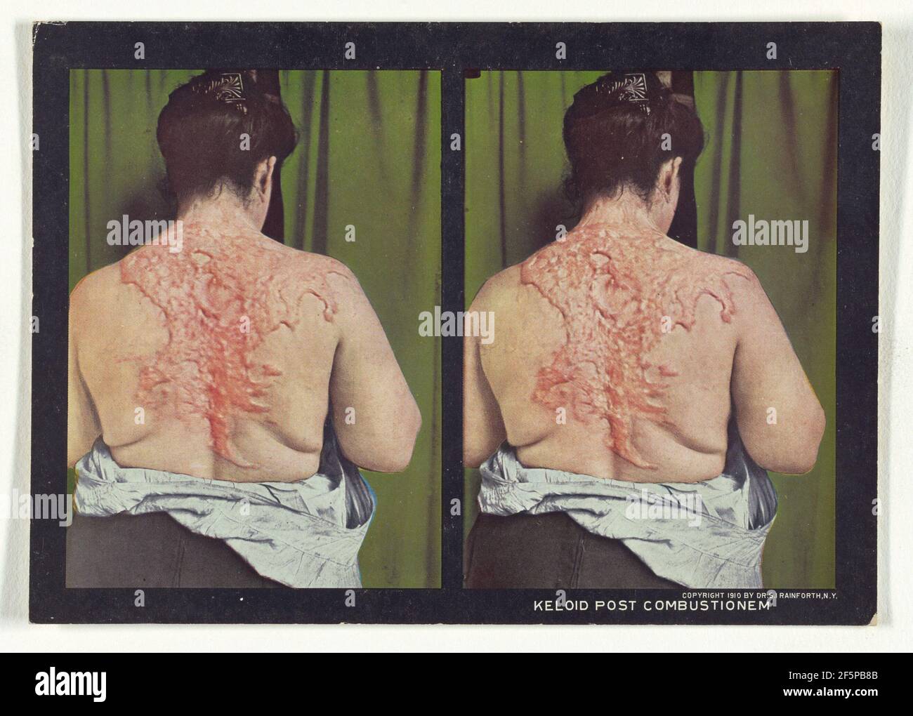 Keloid Post Combtionem. Dr. Selden I. Rainfforth (americano, 1879 - 1960) Foto Stock